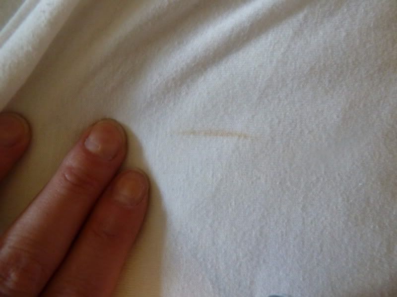 Bed Bug Bite Marks Back
