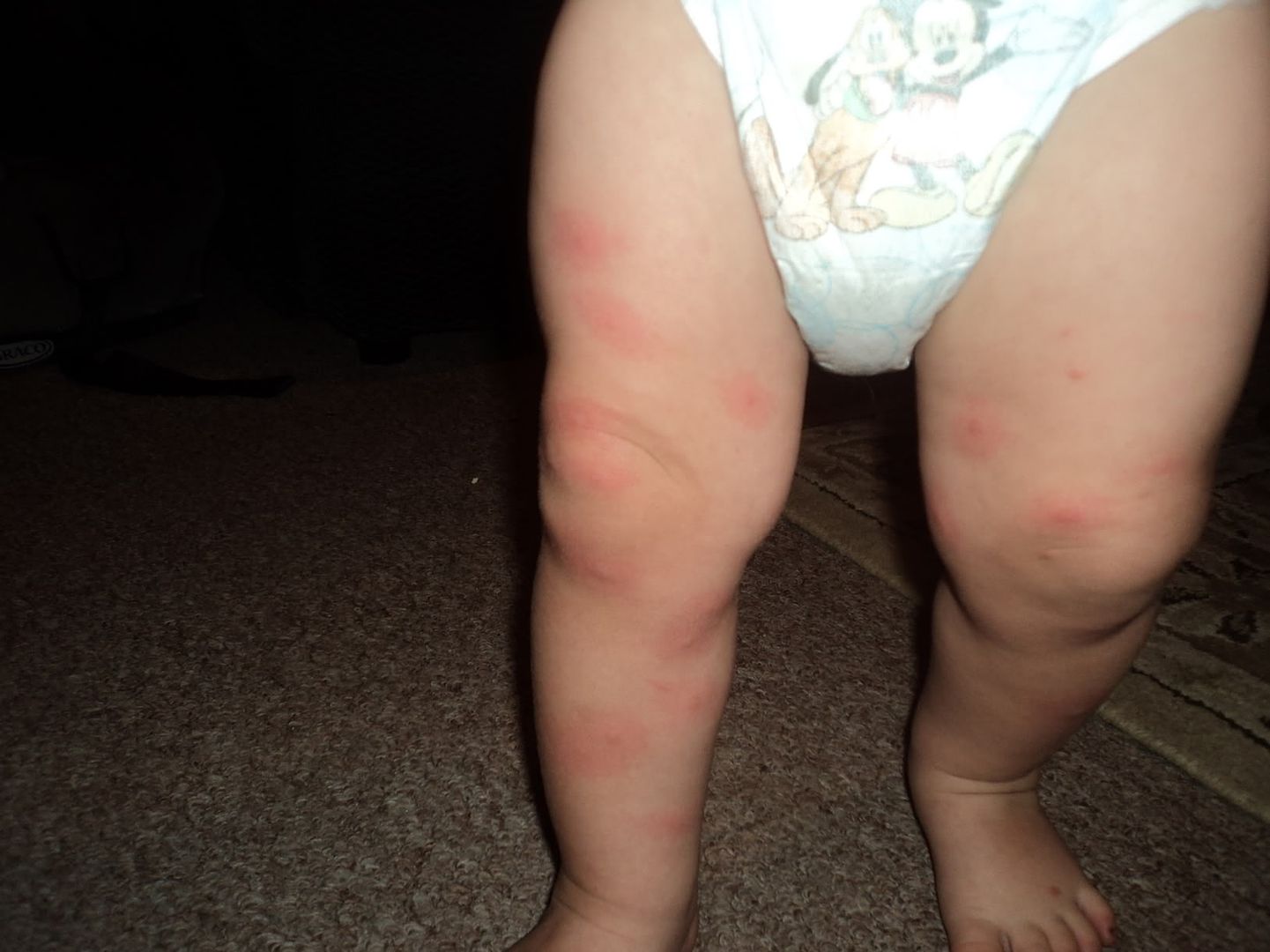 Bed Bug Bites On Babies