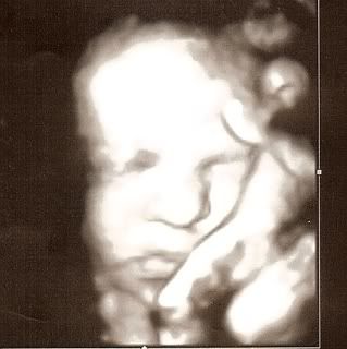 down syndrome ultrasound 4d